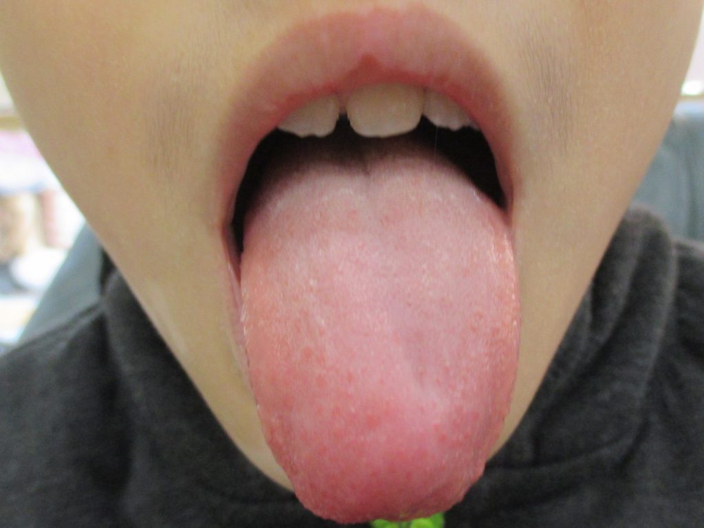 整个舌头都发白 后舌厚 上面都有小红点 还有齿痕_百度知道